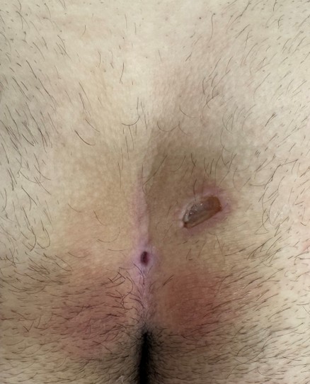 Sinus Pilonidal