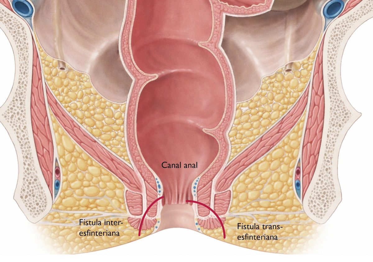 fistula anal