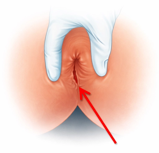 fisura anal