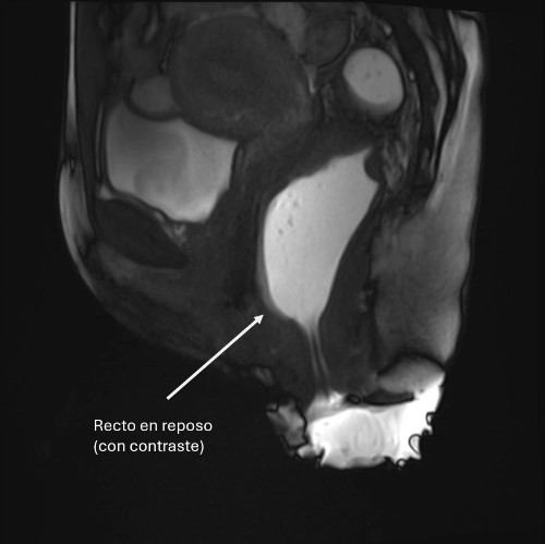 rectocele