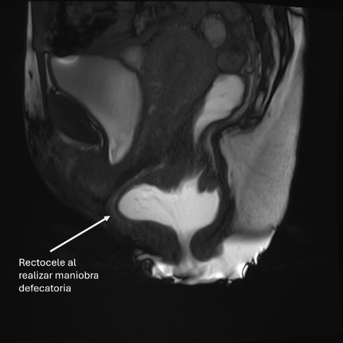 rectocele2
